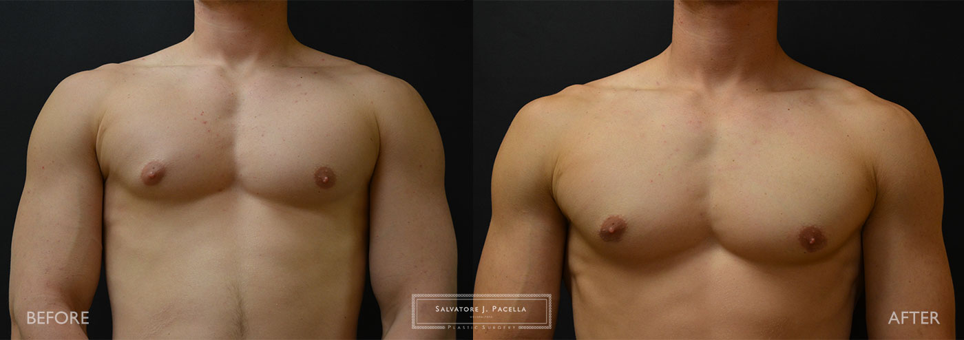 San Diego | La Jolla | Carmel Valley | Del Mar | Encinitas | Plastic Surgery | Gynecomastia | Male Breast Reduction | Top Plastic Surgeon