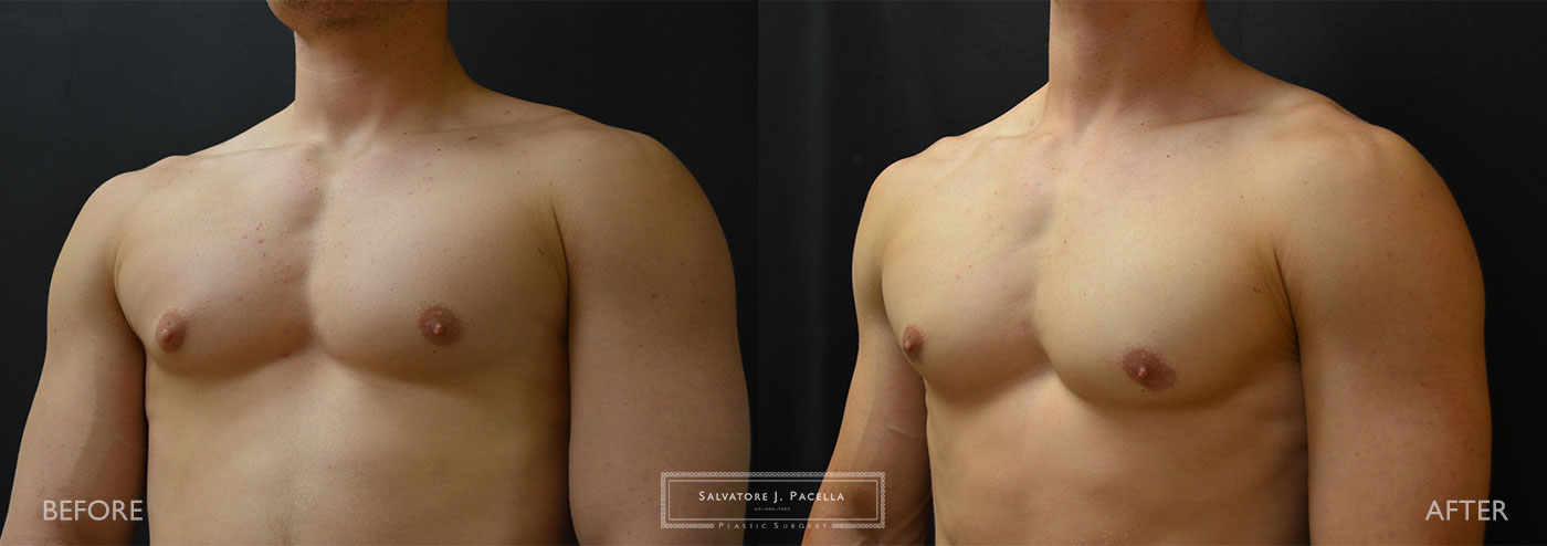 San Diego | La Jolla | Carmel Valley | Del Mar | Encinitas | Plastic Surgery | Gynecomastia | Male Breast Reduction | Top Plastic Surgeon