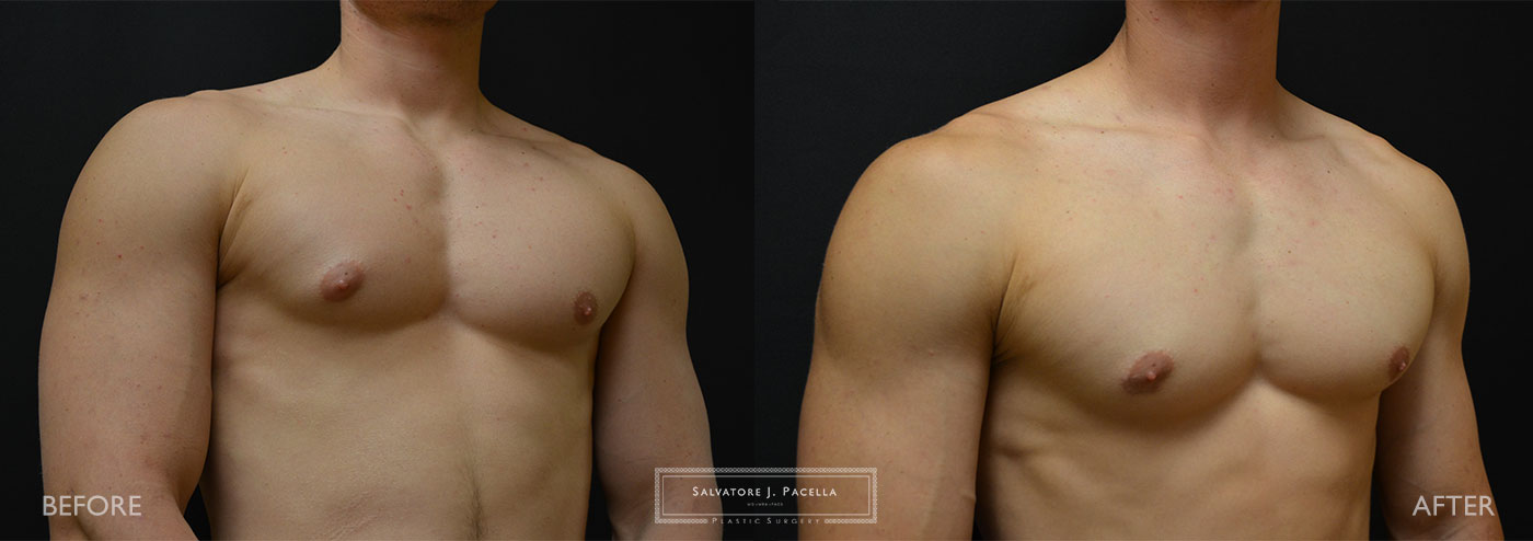 San Diego | La Jolla | Carmel Valley | Del Mar | Encinitas | Plastic Surgery | Gynecomastia | Male Breast Reduction | Top Plastic Surgeon