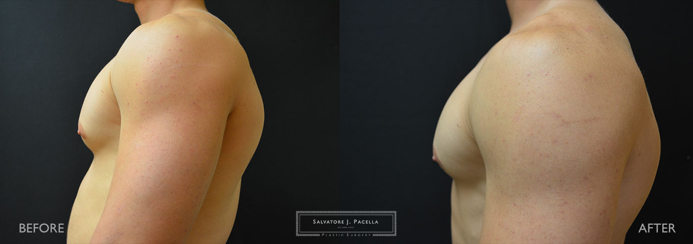 San Diego | La Jolla | Carmel Valley | Del Mar | Encinitas | Plastic Surgery | Gynecomastia | Male Breast Reduction | Top Plastic Surgeon
