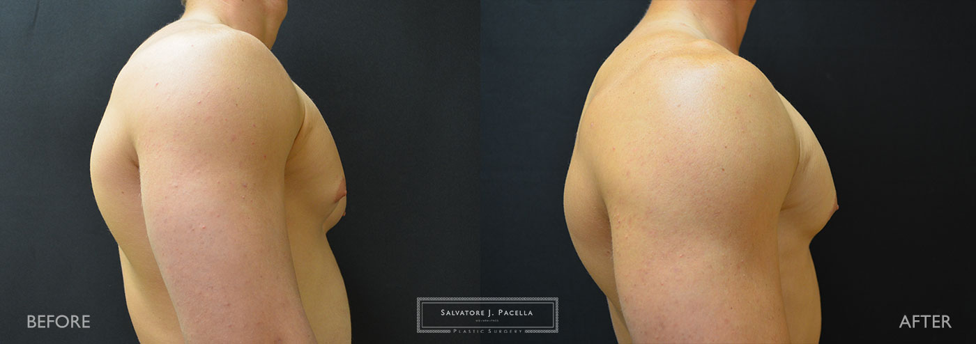 San Diego | La Jolla | Carmel Valley | Del Mar | Encinitas | Plastic Surgery | Gynecomastia | Male Breast Reduction | Top Plastic Surgeon