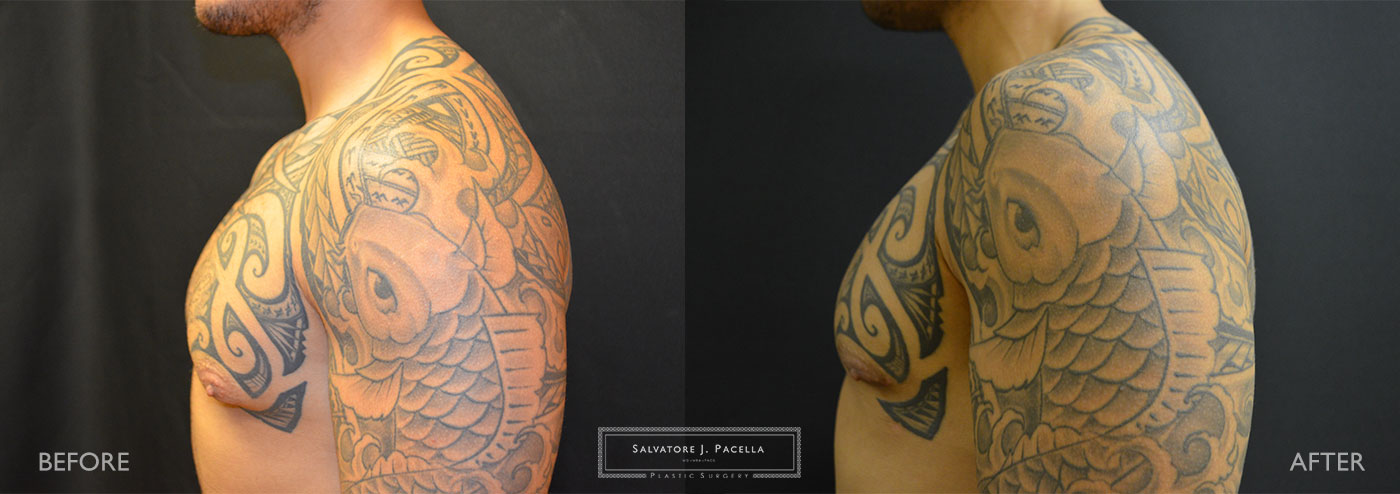 San Diego | La Jolla | Carmel Valley | Del Mar | Encinitas | Plastic Surgery | Gynecomastia | Male Breast Reduction | Top Plastic Surgeon