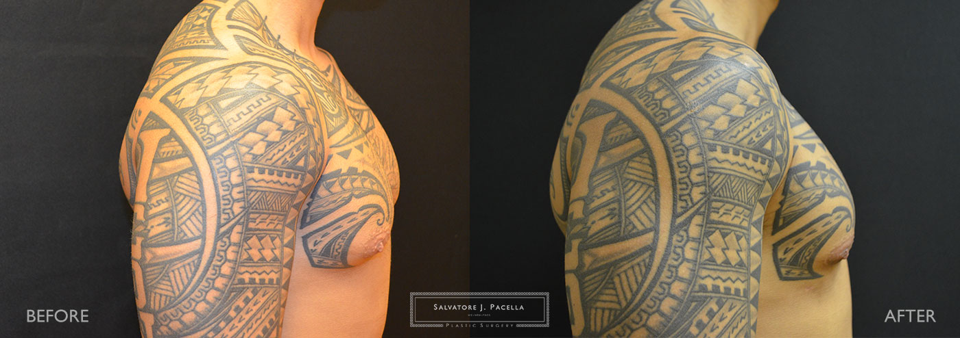 San Diego | La Jolla | Carmel Valley | Del Mar | Encinitas | Plastic Surgery | Gynecomastia | Male Breast Reduction | Top Plastic Surgeon