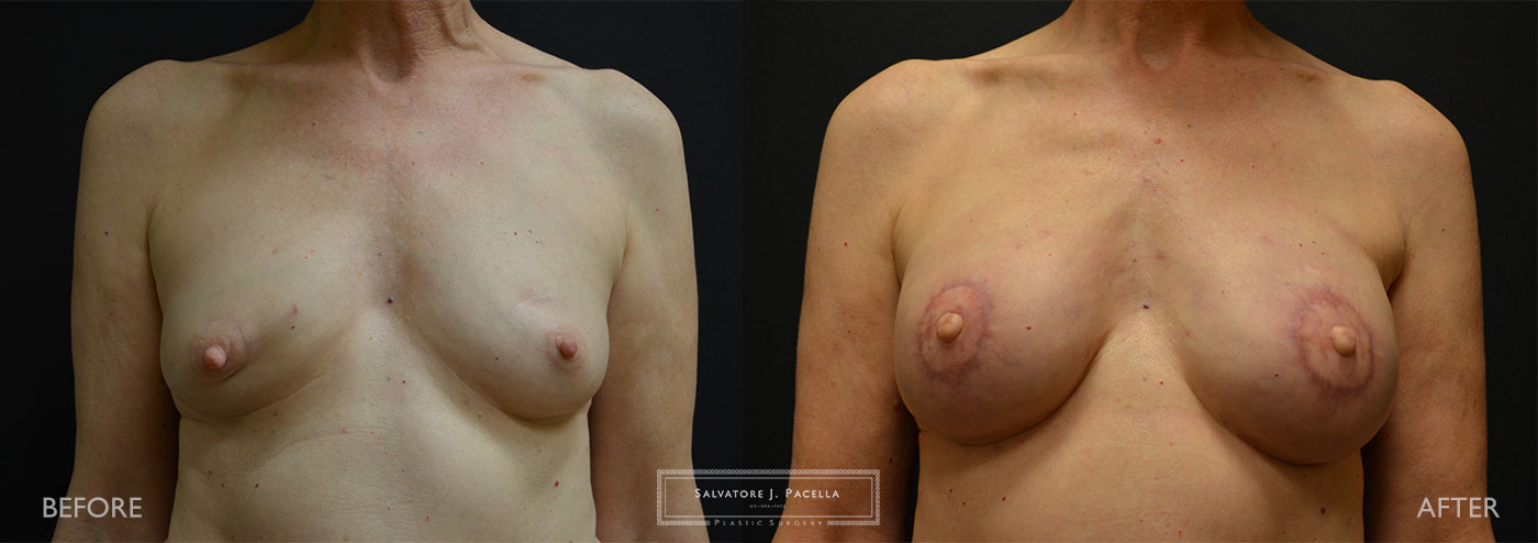 Scripps Plastic Surgeon | Breast Reconstruction | Mastectomy | Breast Implants | Del Mar | San Diego | La Jolla | Plastic Surgery | Reconstructive Surgery | Breast Surgery | Latissimus Flap