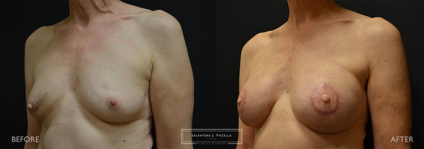Scripps Plastic Surgeon | Breast Reconstruction | Mastectomy | Breast Implants | Del Mar | San Diego | La Jolla | Plastic Surgery | Reconstructive Surgery | Breast Surgery | Latissimus Flap