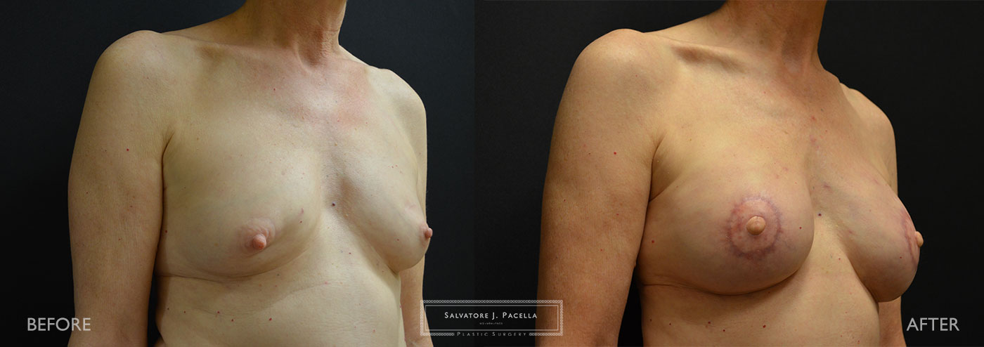 Scripps Plastic Surgeon | Breast Reconstruction | Mastectomy | Breast Implants | Del Mar | San Diego | La Jolla | Plastic Surgery | Reconstructive Surgery | Breast Surgery | Latissimus Flap