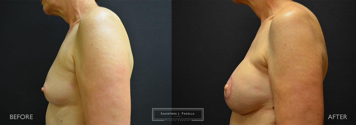 Scripps Plastic Surgeon | Breast Reconstruction | Mastectomy | Breast Implants | Del Mar | San Diego | La Jolla | Plastic Surgery | Reconstructive Surgery | Breast Surgery | Latissimus Flap