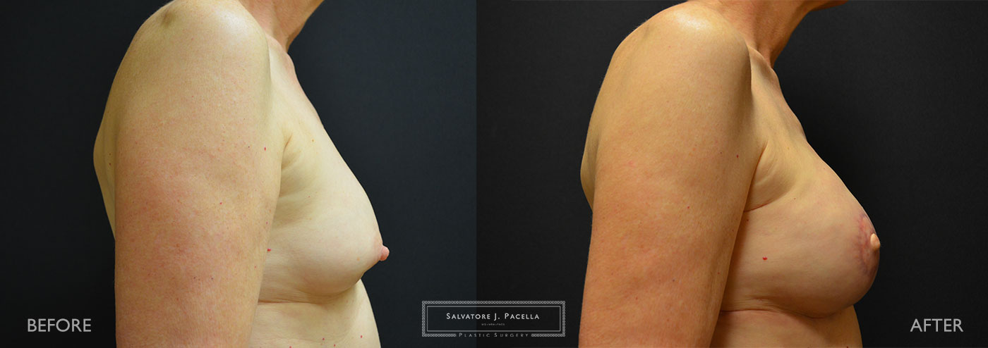 Scripps Plastic Surgeon | Breast Reconstruction | Mastectomy | Breast Implants | Del Mar | San Diego | La Jolla | Plastic Surgery | Reconstructive Surgery | Breast Surgery | Latissimus Flap