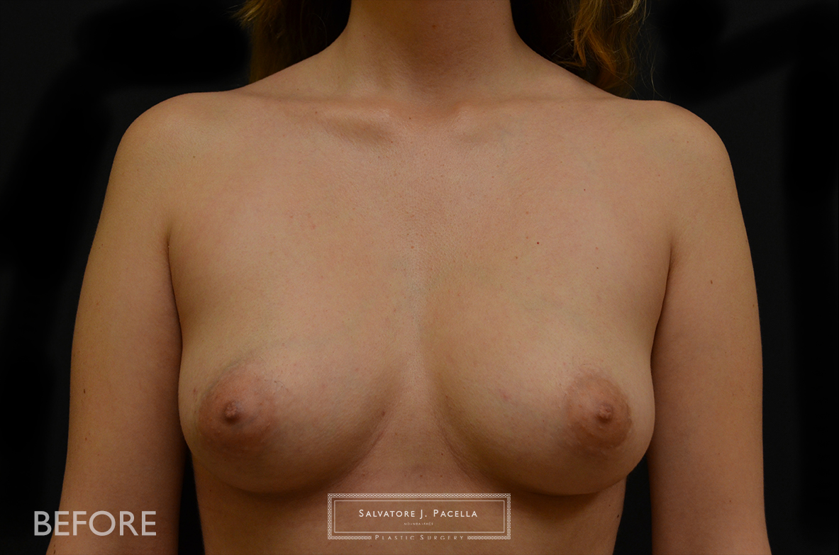 Before image