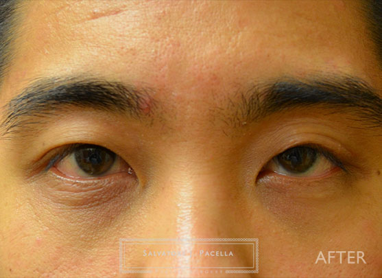 After image