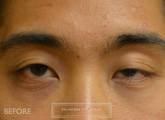 Before image