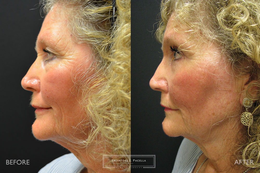 Scripps Plastic Surgeon | Breast Reconstruction | Mastectomy | Breast Implants | Del Mar | San Diego | La Jolla | Plastic Surgery | Reconstructive Surgery | Breast Surgery | Latissimus Flap