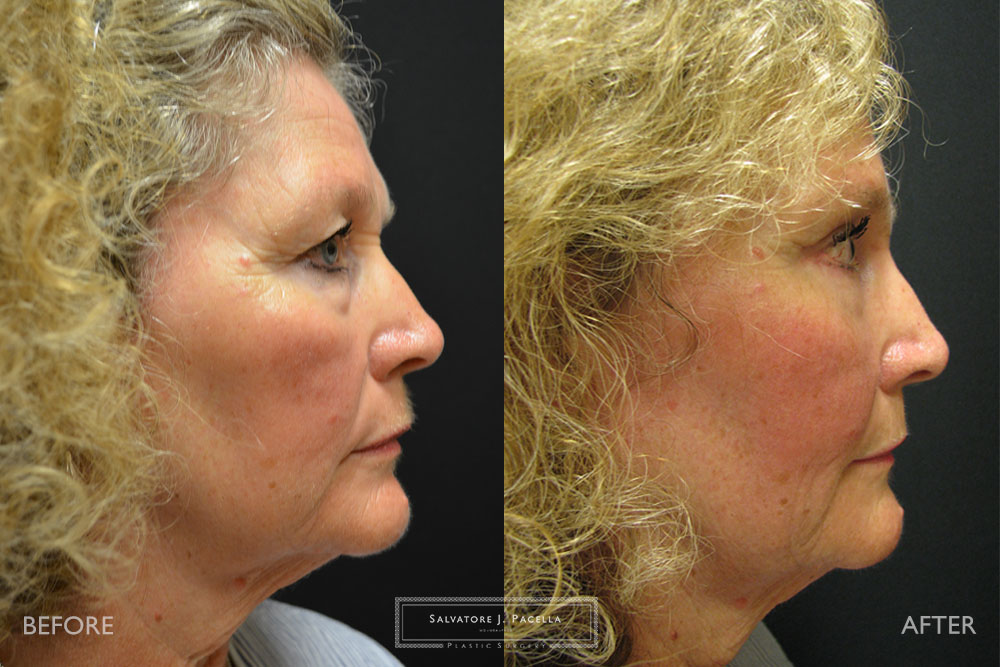 Scripps Plastic Surgeon | Breast Reconstruction | Mastectomy | Breast Implants | Del Mar | San Diego | La Jolla | Plastic Surgery | Reconstructive Surgery | Breast Surgery | Latissimus Flap