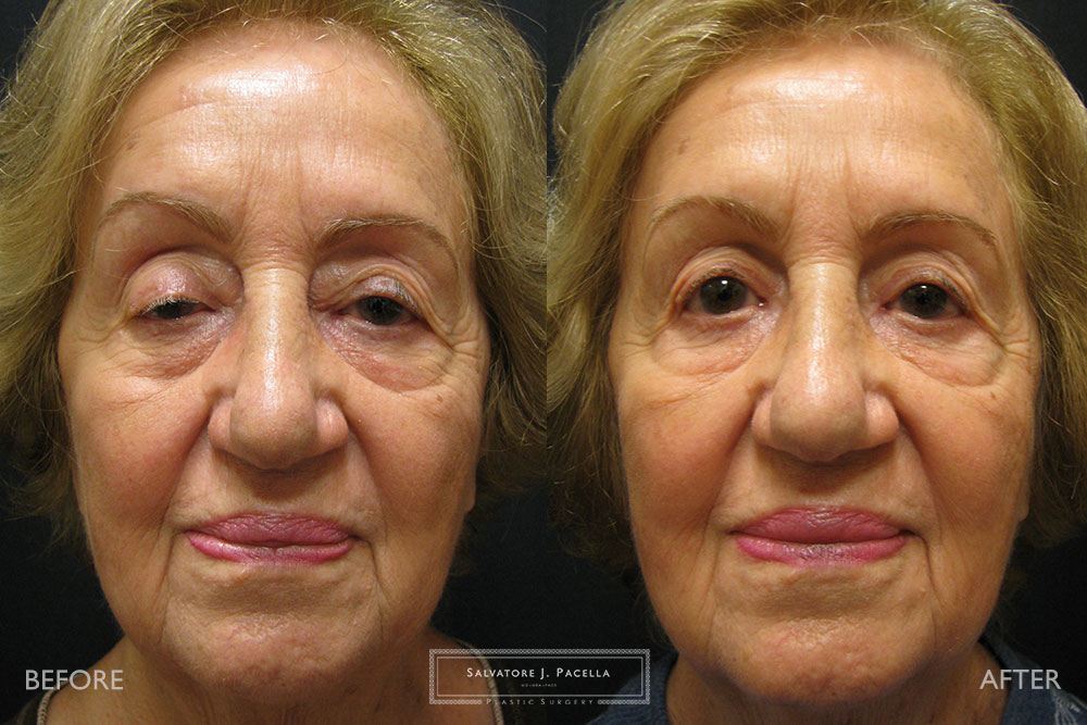 San Diego | La Jolla | Carmel Valley | Del Mar | Encinitas | Plastic Surgery | Cosmetic Surgery | Eyelid Expert | Eyelid Surgery | Ptosis | Oculoplastic Surgery | Browlift | Blepharoplasty | Oculoplastic Surgery | Facial Rejuvenation | Top Plastic Surgeon