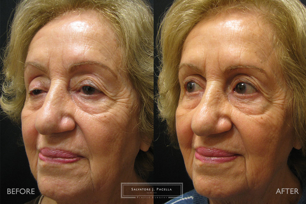 San Diego | La Jolla | Carmel Valley | Del Mar | Encinitas | Plastic Surgery | Cosmetic Surgery | Eyelid Expert | Eyelid Surgery | Ptosis | Oculoplastic Surgery | Browlift | Blepharoplasty | Oculoplastic Surgery | Facial Rejuvenation | Top Plastic Surgeon