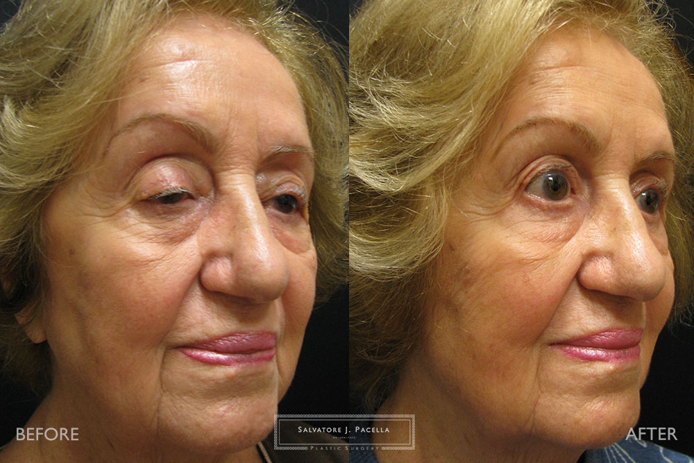 San Diego | La Jolla | Carmel Valley | Del Mar | Encinitas | Plastic Surgery | Cosmetic Surgery | Eyelid Expert | Eyelid Surgery | Ptosis | Oculoplastic Surgery | Browlift | Blepharoplasty | Oculoplastic Surgery | Facial Rejuvenation | Top Plastic Surgeon