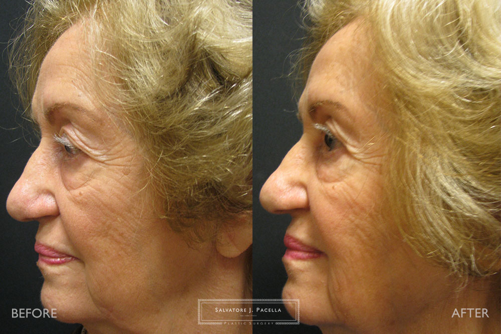 San Diego | La Jolla | Carmel Valley | Del Mar | Encinitas | Plastic Surgery | Cosmetic Surgery | Eyelid Expert | Eyelid Surgery | Ptosis | Oculoplastic Surgery | Browlift | Blepharoplasty | Oculoplastic Surgery | Facial Rejuvenation | Top Plastic Surgeon