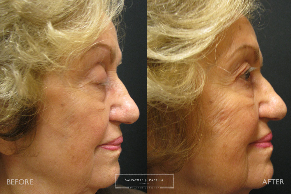 San Diego | La Jolla | Carmel Valley | Del Mar | Encinitas | Plastic Surgery | Cosmetic Surgery | Eyelid Expert | Eyelid Surgery | Ptosis | Oculoplastic Surgery | Browlift | Blepharoplasty | Oculoplastic Surgery | Facial Rejuvenation | Top Plastic Surgeon