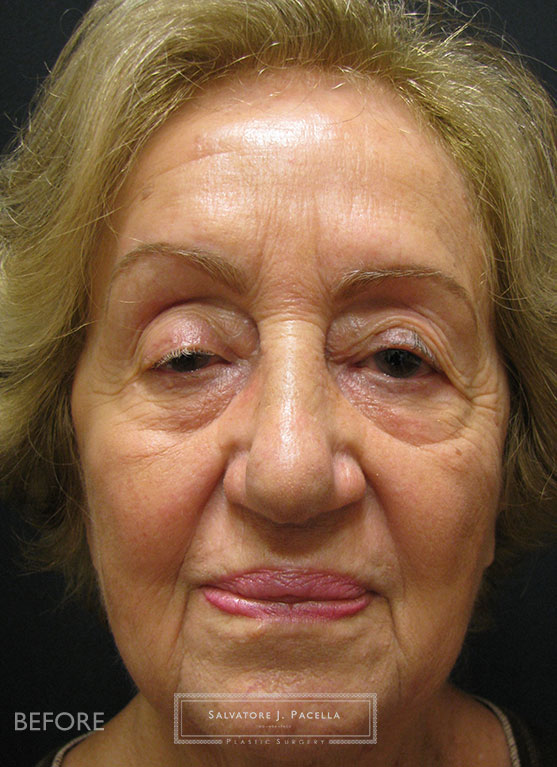 Before image