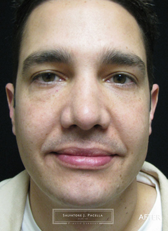After image