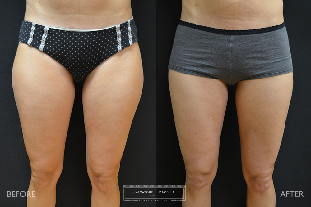San Diego | La Jolla | Carmel Valley | Del Mar | Encinitas | Plastic Surgery | Body Contouring | Liposuction | Top Plastic Surgeon | Body Contouring