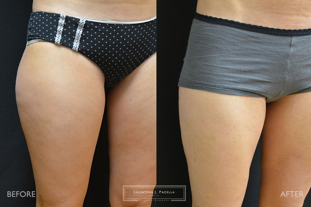 San Diego | La Jolla | Carmel Valley | Del Mar | Encinitas | Plastic Surgery | Body Contouring | Liposuction | Top Plastic Surgeon | Body Contouring
