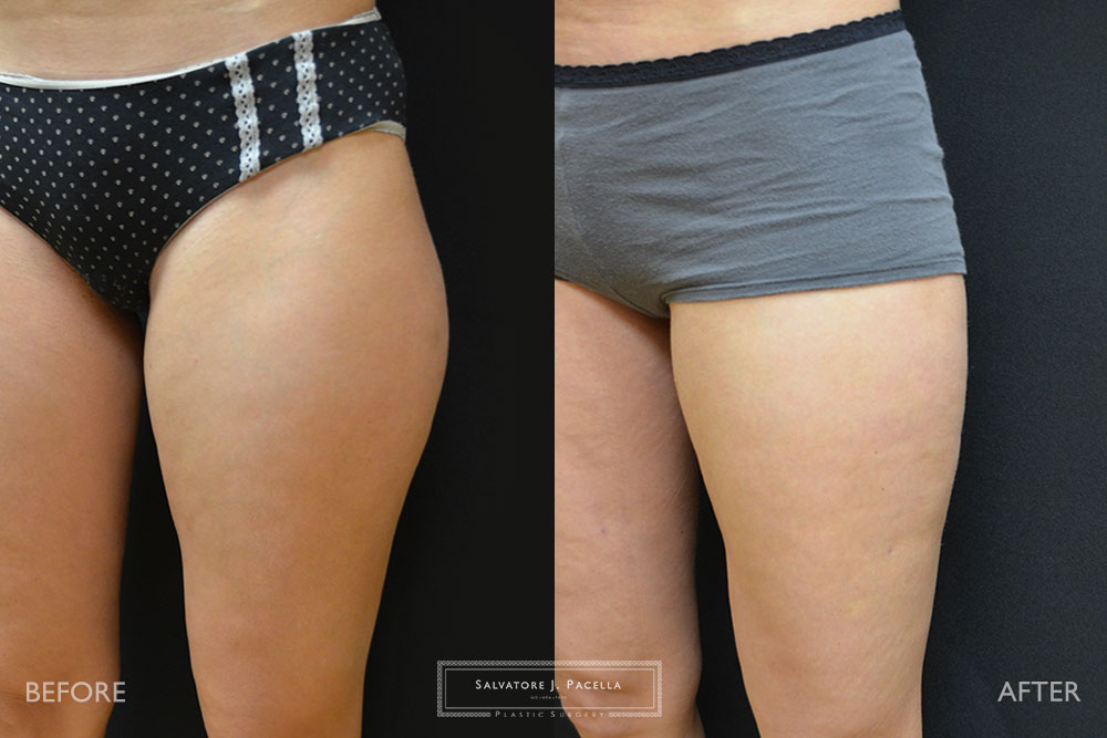 San Diego | La Jolla | Carmel Valley | Del Mar | Encinitas | Plastic Surgery | Body Contouring | Liposuction | Top Plastic Surgeon | Body Contouring