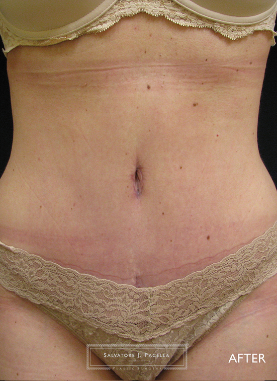 After image