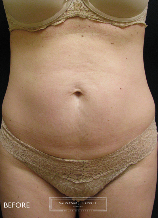 Before image