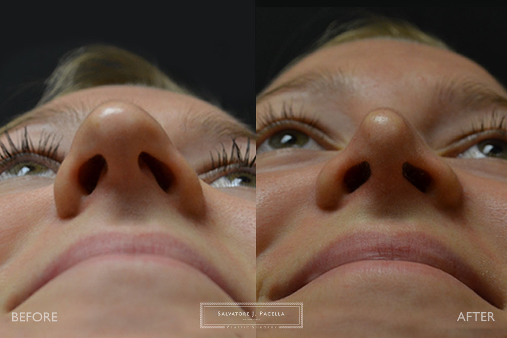 San Diego | La Jolla | Carmel Valley | Del Mar | Encinitas | Plastic Surgery | Cosmetic Surgery | Nose Job | Chin Implant | Top Plastic Surgeon | Scripps Plastic Surgeon | Rhinoplasty