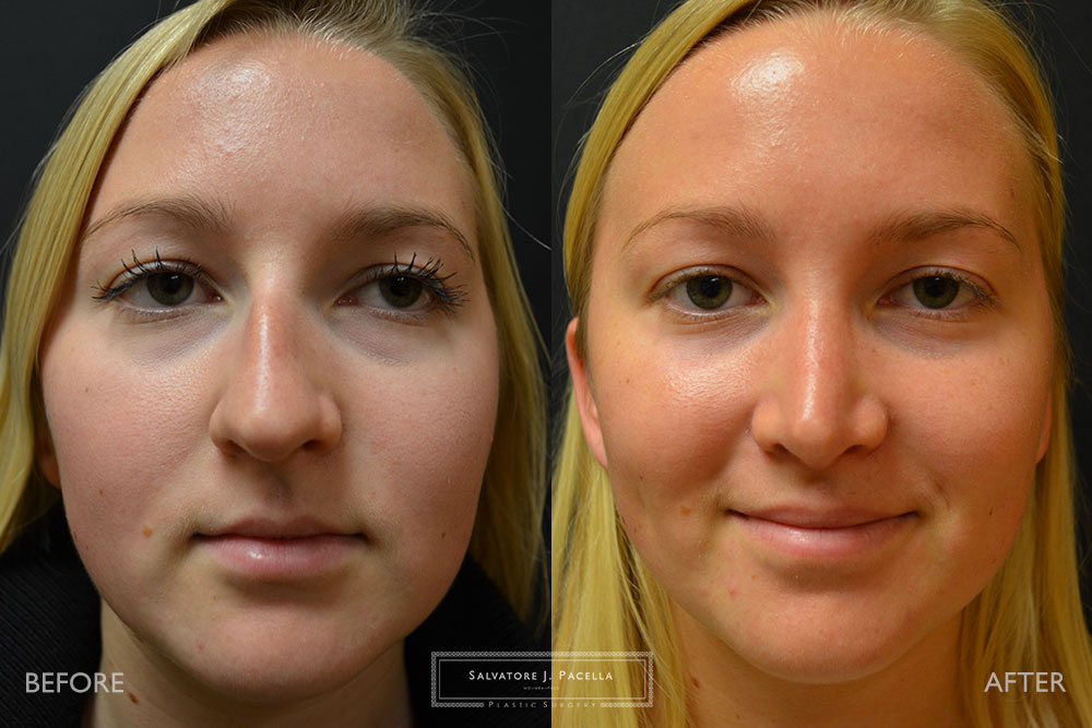 San Diego | La Jolla | Carmel Valley | Del Mar | Encinitas | Plastic Surgery | Cosmetic Surgery | Nose Job | Chin Implant | Top Plastic Surgeon | Scripps Plastic Surgeon | Rhinoplasty