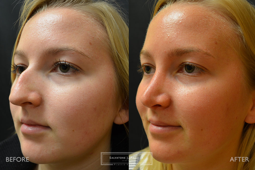 San Diego | La Jolla | Carmel Valley | Del Mar | Encinitas | Plastic Surgery | Cosmetic Surgery | Nose Job | Chin Implant | Top Plastic Surgeon | Scripps Plastic Surgeon | Rhinoplasty