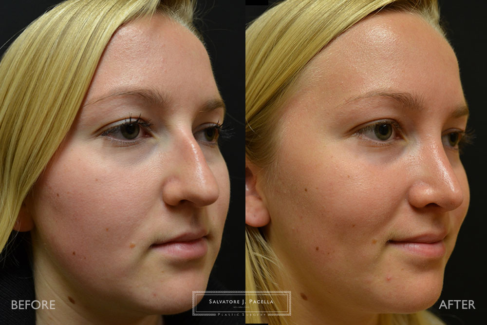 San Diego | La Jolla | Carmel Valley | Del Mar | Encinitas | Plastic Surgery | Cosmetic Surgery | Nose Job | Chin Implant | Top Plastic Surgeon | Scripps Plastic Surgeon | Rhinoplasty