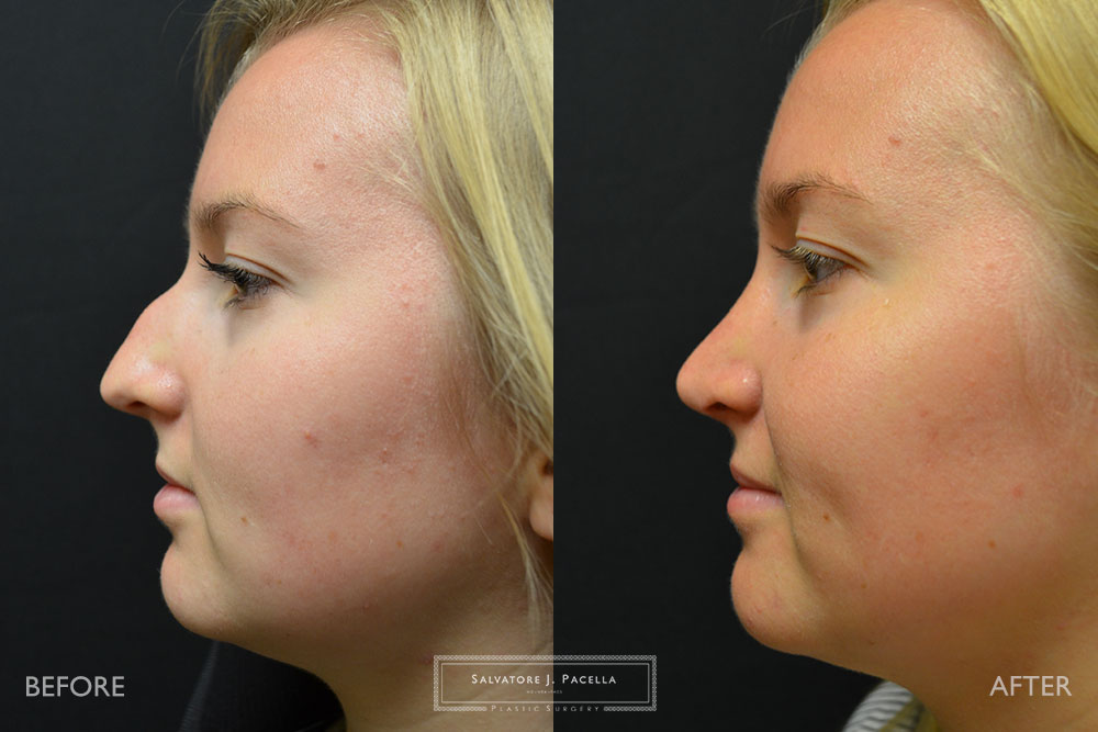 San Diego | La Jolla | Carmel Valley | Del Mar | Encinitas | Plastic Surgery | Cosmetic Surgery | Nose Job | Chin Implant | Top Plastic Surgeon | Scripps Plastic Surgeon | Rhinoplasty