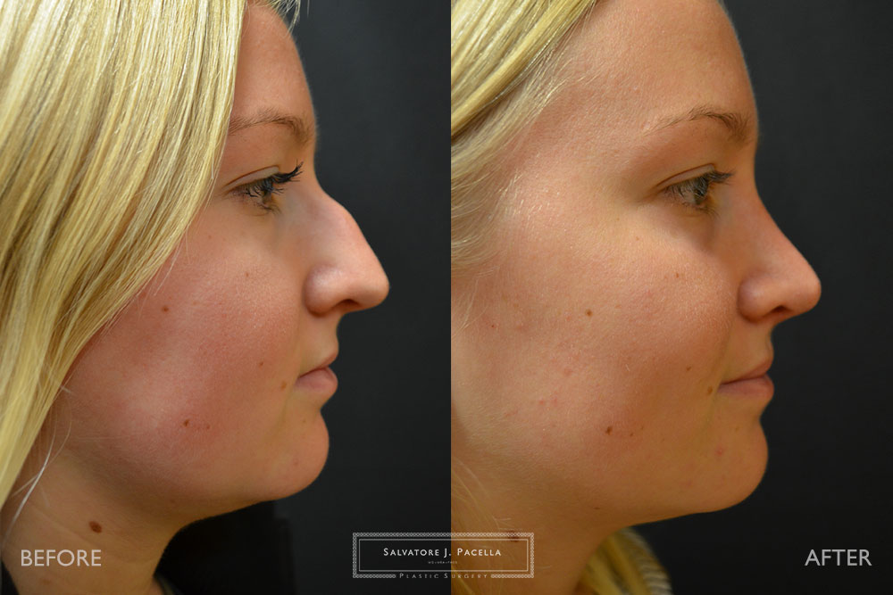San Diego | La Jolla | Carmel Valley | Del Mar | Encinitas | Plastic Surgery | Cosmetic Surgery | Nose Job | Chin Implant | Top Plastic Surgeon | Scripps Plastic Surgeon | Rhinoplasty