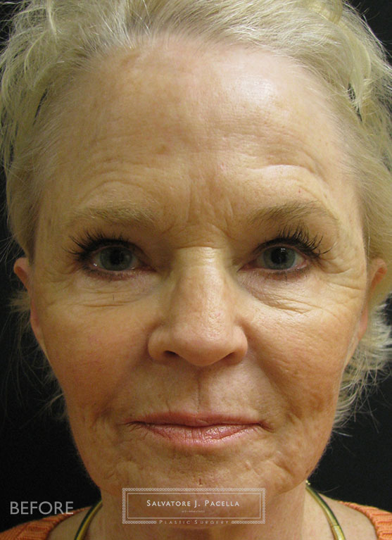 Before image