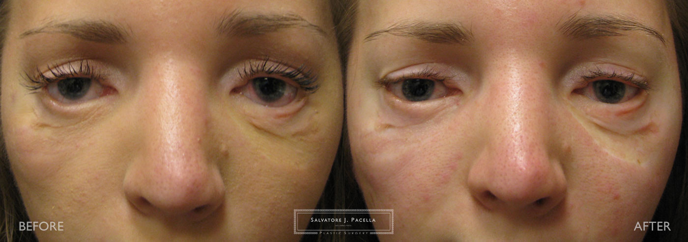 Eyelid expert | oculoplastic | ectropion | plastic surgery | Scripps plastic surgery | La Jolla | Carmel Valley | Del Mar | San Diego