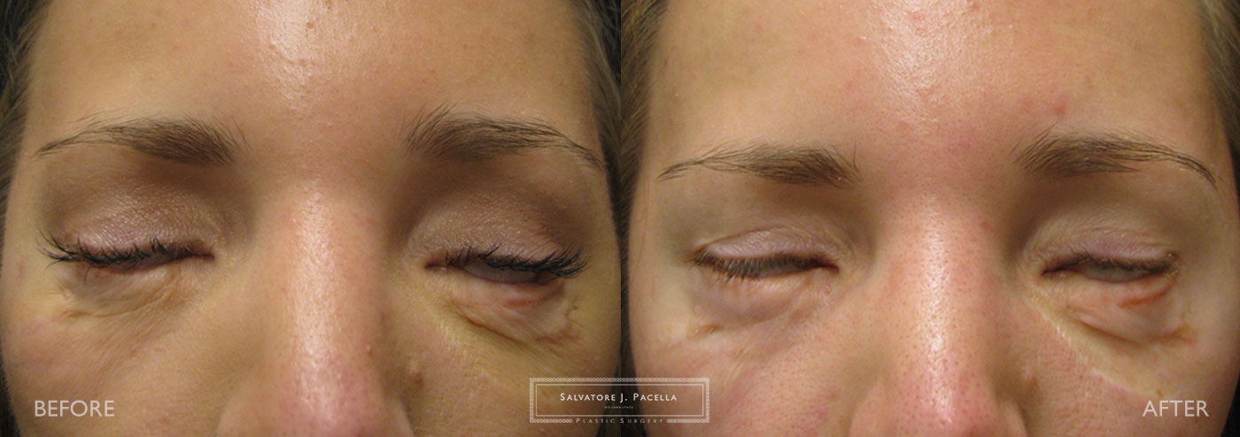 Eyelid expert | oculoplastic | ectropion | plastic surgery | Scripps plastic surgery | La Jolla | Carmel Valley | Del Mar | San Diego