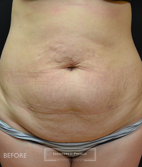 San Diego | La Jolla | Carmel Valley | Del Mar | Encinitas | Plastic Surgery | Body Contouring | Tummy Tuck | Mommy Makeover | Boob Job | Breast Augmentation | Top Plastic Surgeon | Abdominoplasty