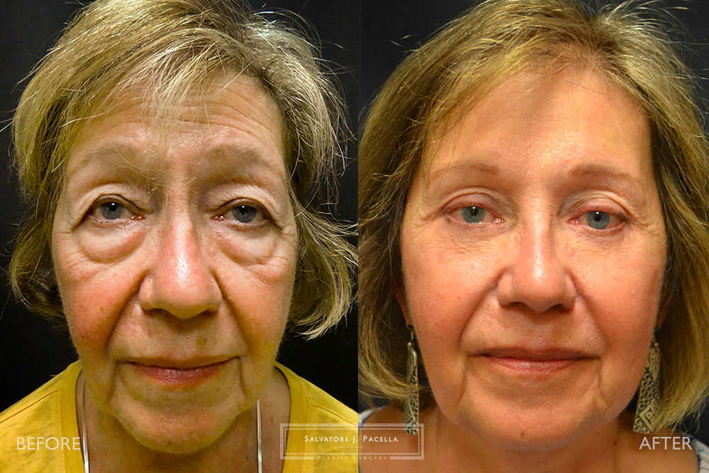 San Diego | La Jolla | Carmel Valley | Del Mar | Encinitas | Plastic Surgery | Cosmetic Surgery | Eyelid Expert | Eyelid Surgery | Malar bags | Eye Bags | Browlift | Blepharoplasty | Neck Lipo | Oculoplastic Surgery | Facial Rejuvenation | Top Plastic Surgeon