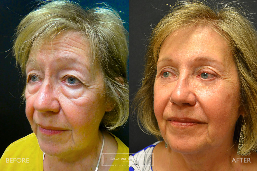 San Diego | La Jolla | Carmel Valley | Del Mar | Encinitas | Plastic Surgery | Cosmetic Surgery | Eyelid Expert | Eyelid Surgery | Malar bags | Eye Bags | Browlift | Blepharoplasty | Neck Lipo | Oculoplastic Surgery | Facial Rejuvenation | Top Plastic Surgeon