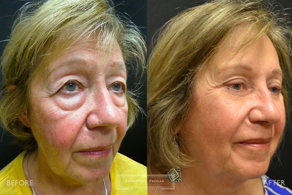 San Diego | La Jolla | Carmel Valley | Del Mar | Encinitas | Plastic Surgery | Cosmetic Surgery | Eyelid Expert | Eyelid Surgery | Malar bags | Eye Bags | Browlift | Blepharoplasty | Neck Lipo | Oculoplastic Surgery | Facial Rejuvenation | Top Plastic Surgeon