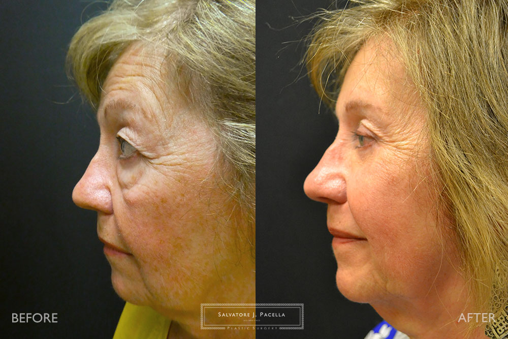 San Diego | La Jolla | Carmel Valley | Del Mar | Encinitas | Plastic Surgery | Cosmetic Surgery | Eyelid Expert | Eyelid Surgery | Malar bags | Eye Bags | Browlift | Blepharoplasty | Neck Lipo | Oculoplastic Surgery | Facial Rejuvenation | Top Plastic Surgeon