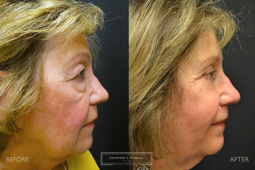 San Diego | La Jolla | Carmel Valley | Del Mar | Encinitas | Plastic Surgery | Cosmetic Surgery | Eyelid Expert | Eyelid Surgery | Malar bags | Eye Bags | Browlift | Blepharoplasty | Neck Lipo | Oculoplastic Surgery | Facial Rejuvenation | Top Plastic Surgeon