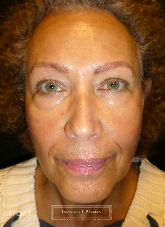 Before image