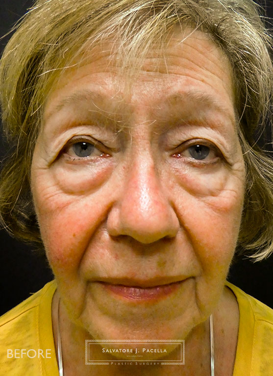 Before image