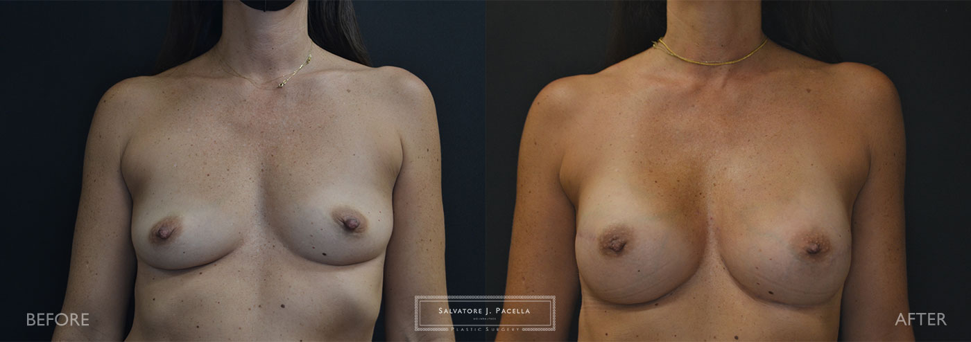 Scripps Plastic Surgeon | Breast Reconstruction | Mastectomy | Breast Implants | Del Mar | an Diego | La Jolla | Plastic Surgery | Reconstructive Surgery | Breast Surgery | Tissue expanders | Artoura | Mentor breast implants
