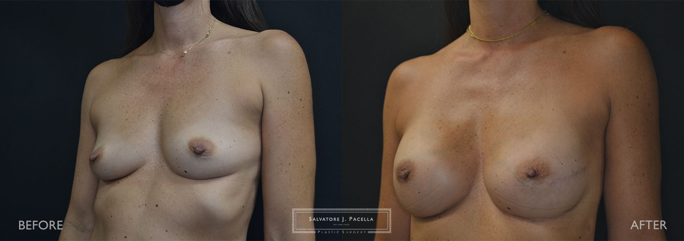 Scripps Plastic Surgeon | Breast Reconstruction | Mastectomy | Breast Implants | Del Mar | an Diego | La Jolla | Plastic Surgery | Reconstructive Surgery | Breast Surgery | Tissue expanders | Artoura | Mentor breast implants