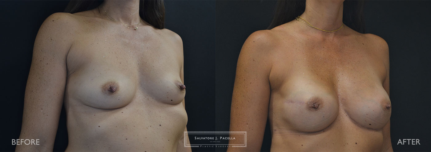 Scripps Plastic Surgeon | Breast Reconstruction | Mastectomy | Breast Implants | Del Mar | an Diego | La Jolla | Plastic Surgery | Reconstructive Surgery | Breast Surgery | Tissue expanders | Artoura | Mentor breast implants