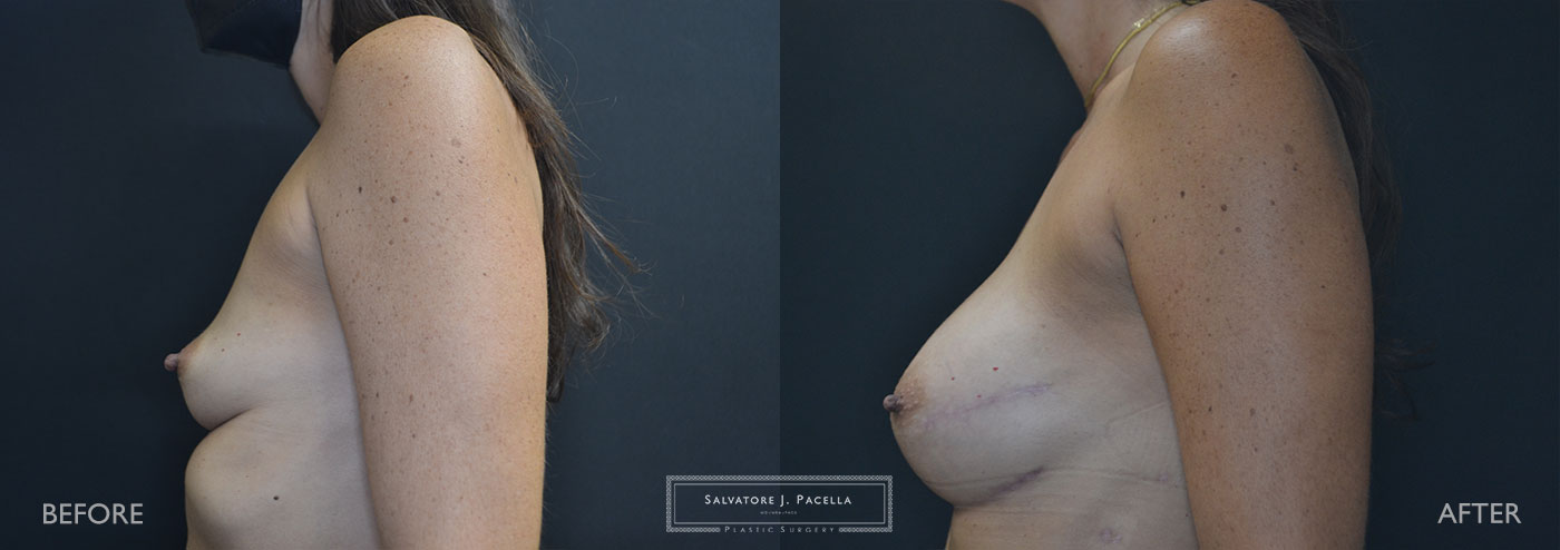 Scripps Plastic Surgeon | Breast Reconstruction | Mastectomy | Breast Implants | Del Mar | an Diego | La Jolla | Plastic Surgery | Reconstructive Surgery | Breast Surgery | Tissue expanders | Artoura | Mentor breast implants